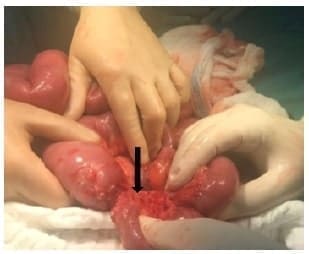 Zona de estenosis en el intestino delgado Zona de estenosis en el intestino delgado