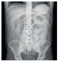 Falta de progresión del medio de contraste - Mesenteritis Esclerosante Falta de progresión del medio de contraste - Mesenteritis Esclerosante