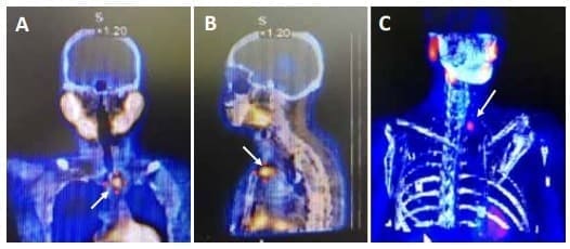 Gammagrafía de paratiroides con SPECT-CT