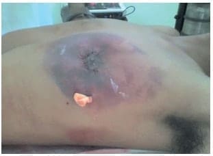 Hematoma, complicación postoperatoria