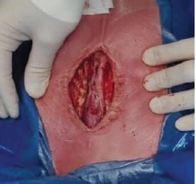 Incisión en línea media torácica - Agenesia Esternal Total