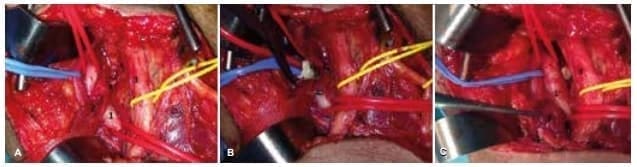 Isquemia Crítica Miembros Inferiores - Arteria poplítea Isquemia Crítica Miembros Inferiores - Arteria poplítea