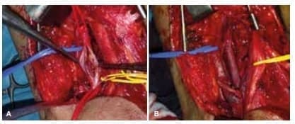 Arteriotomía longitudinal Arteriotomía longitudinal