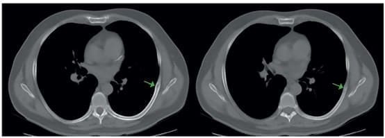 Lesión lítica en el séptimo arco costal Lesión lítica en el séptimo arco costal