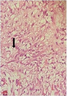 Mesenteritis Esclerosante - Lipodistrofia del mesenterio Mesenteritis Esclerosante - Lipodistrofia del mesenterio