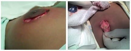 Incisión periareolar de la mama en paciente varón