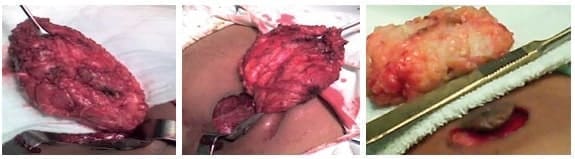 Mastectomía subcutánea simple