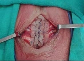 Neoesternón fijado a la pared torácica anterior