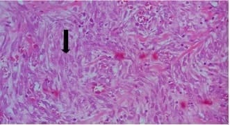 Fibroblastos en la subserosa y meso del intestino delgado Fibroblastos en la
subserosa y meso del intestino delgado