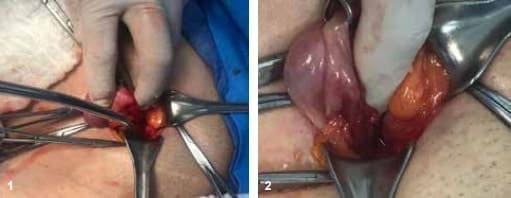 Región inguinal derecha Región inguinal derecha