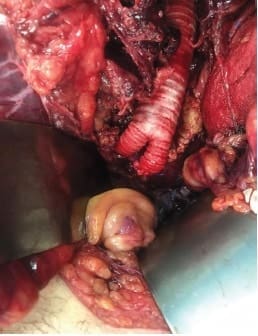 Reparación abierta de AAA con un injerto sintético bifurcado de 30 mm Reparación abierta de AAA con un injerto sintético
bifurcado de 30 mm