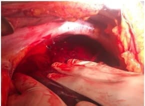 Ruptura hepática de los segmentos VII – VIII Ruptura hepática de los segmentos VII – VIII