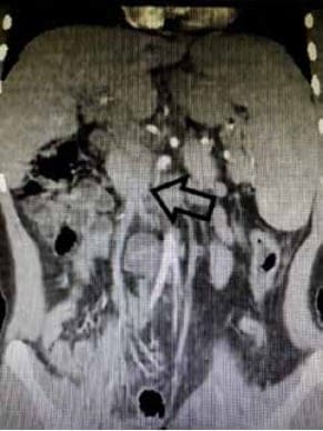 Corte coronal de tomografía de abdomen