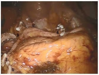 Vaciamiento suprapancreático Vaciamiento suprapancreático