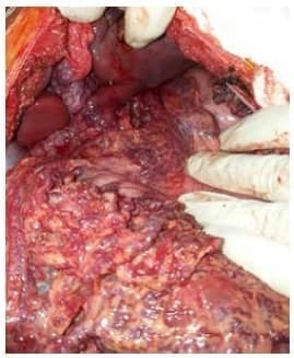 Várices en el epiplón mayor Várices en el epiplón mayor