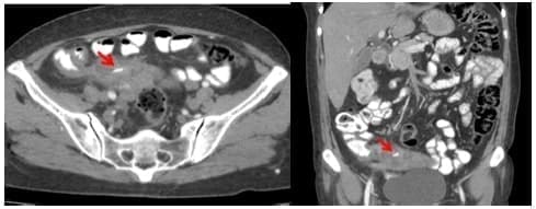 Tomografia computarizada de abdomen con contraste, la flecha señala el cuerpo extraño Tomografia computarizada de abdomen con contraste, la flecha señala el cuerpo extraño