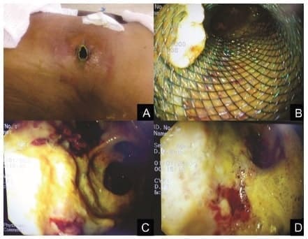 Abordaje endoscópico del retroperitoneo Abordaje endoscópico del retroperitoneo