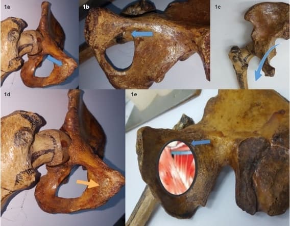 Anatomía del agujero obturador Anatomía del agujero obturador