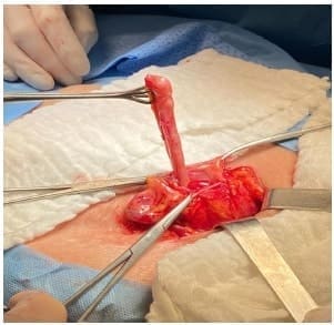 Apéndice cecal con hiperemia Apéndice cecal con hiperemia