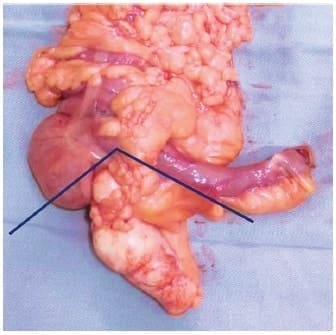 Apendicectomía radical - Neoplasias Apendiculares Incidentales Apendicectomía radical - Neoplasias Apendiculares Incidentales