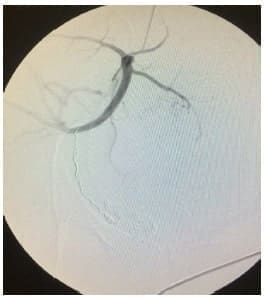 Preservando las arterias glútea y vesical Preservando las arterias glútea y vesical