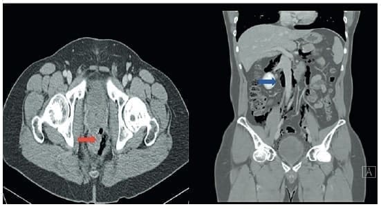 Burbujas de aire atípico en la grasa para rectal 