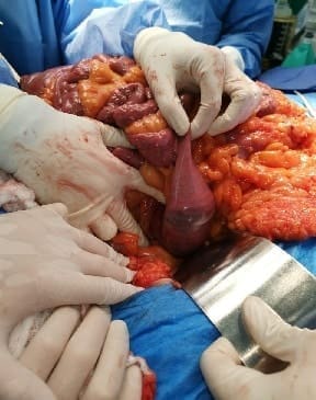 Cálculo de 10 x 5 cm en el duodeno