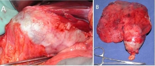 Carcinoma de vesícula biliar Carcinoma de vesícula biliar