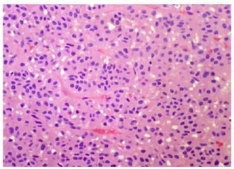 Células neoplásicas “Organoide” Células neoplásicas “Organoide”