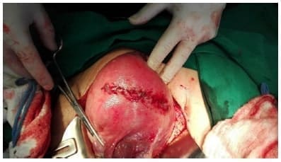 Aspecto de la cirugía donde se observa la cesárea fúndica Aspecto de la cirugía donde se observa la cesárea fúndica