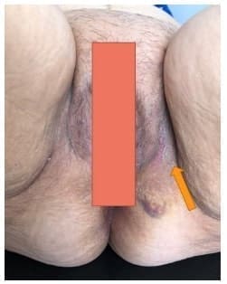 Imagen posoperatoria un mes después de la cirugía, Hernia Perineal Primaria Imagen posoperatoria un mes después de la
cirugía, Hernia Perineal Primaria