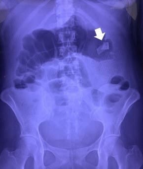 Cinta radiopaca de compresa quirúrgica - Migración Completa de Textilom Cinta radiopaca de compresa quirúrgica - Migración Completa de Textilom