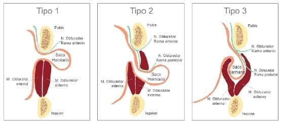 Clasificación de la hernia obturatriz Clasificación de la hernia obturatriz