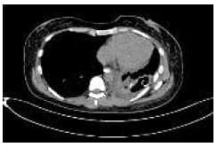 Colección pleural izquierda producto de la fistula Colección pleural izquierda producto de la fistula