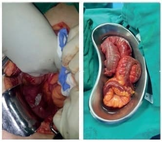 Defecto herniario interrectovaginal Defecto herniario interrectovaginal