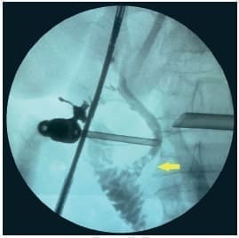 Colangiografia intraoperatoria donde se aprecian varios defectos de llenamiento Colangiografia intraoperatoria donde se aprecian varios defectos de llenamiento