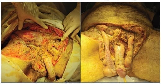 Tratamiento quirúrgico con un desbridamiento agresivo en el paciente - Gangrena de Fournier Tratamiento quirúrgico con un desbridamiento agresivo en el paciente - Gangrena de Fournier