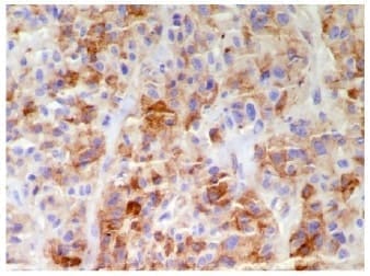 Diagnóstico de feocromocitoma Diagnóstico de feocromocitoma