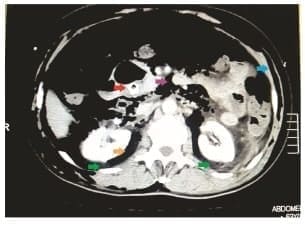 Disección aérea masiva subcutánea Disección aérea masiva subcutánea