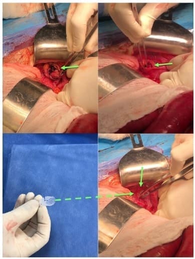 Disección del saco herniario y corrección del defecto Disección del saco herniario y corrección del defecto