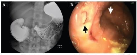 Divertículo duodenal intraluminal gigante Divertículo duodenal intraluminal gigante