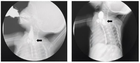 Divertículo faringoesofágico