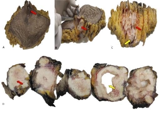 Elipse de piel de la pieza quirúrgica Elipse de piel de la pieza quirúrgica