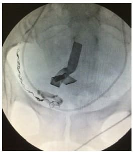 Embolización con microcoils Embolización con microcoils
