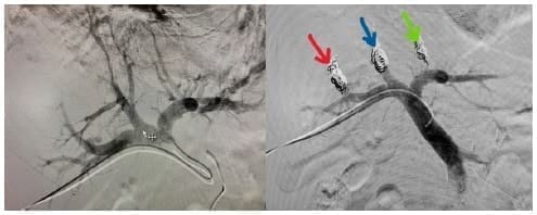 Embolización supra selectiva de ramos portales hacia sectores centrales - Mesohepatectomía Embolización supra selectiva de ramos portales hacia sectores centrales - Mesohepatectomía
