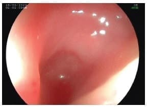 Endoscopia de vías digestivas altas
