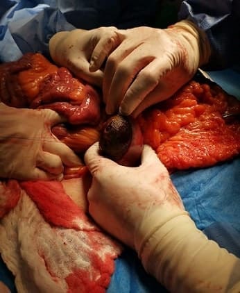 Enterotomía longitudinal para la extracción del
cálculo