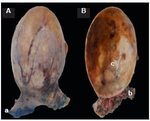 Hallazgos macroscópicos en espécimen de resección Hallazgos macroscópicos en espécimen de resección