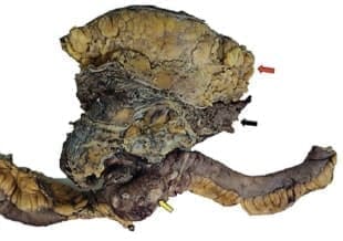 Espécimen de resección quirúrgica - Carcinoma Escamocelular de Ombligo Espécimen de resección quirúrgica - Carcinoma Escamocelular de Ombligo