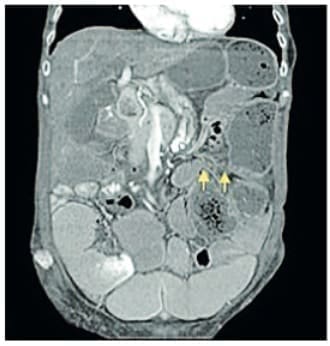 Estriación del meso del sigmoide Estriación del meso del sigmoide